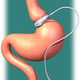 Illustration for article titled Bone-Headed Move: FDA Panel OKs Lap-Band Rule Changes
